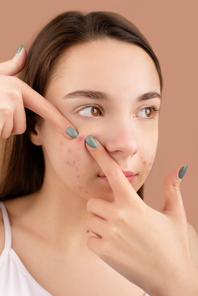 Close-up of a young woman with acne