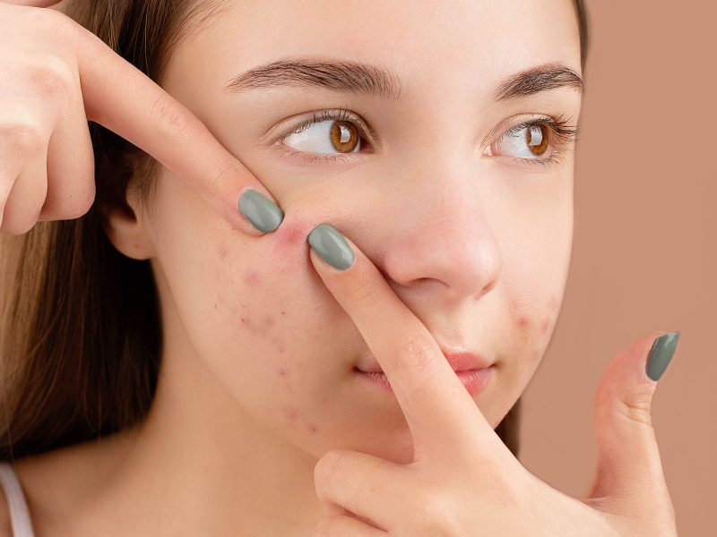 Close-up of a young woman with acne