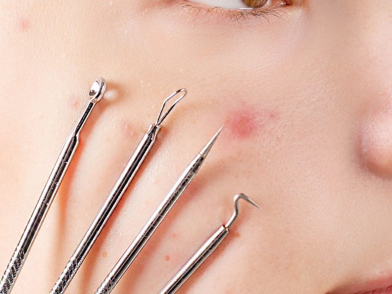 Close-up of skin extraction tools used in dermatological treatment
